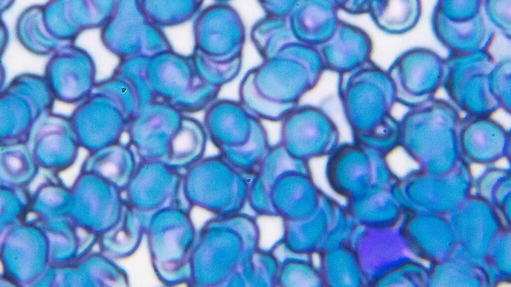 What the study of the mutant gene behind aggressive adult leukaemia can offer for treatment